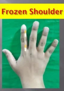 Frozen shoulder treatment using bar magnet in acupressure therapy